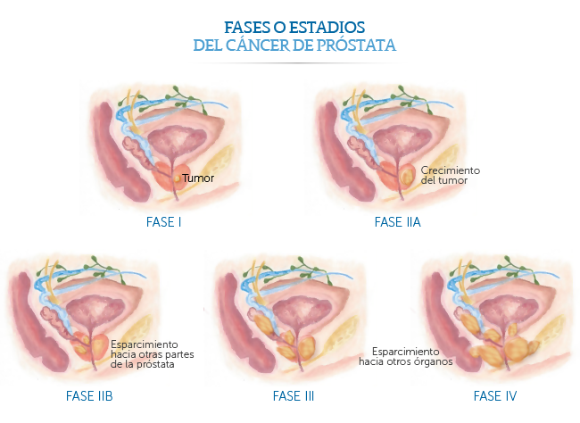 Fases del cancer de prostata