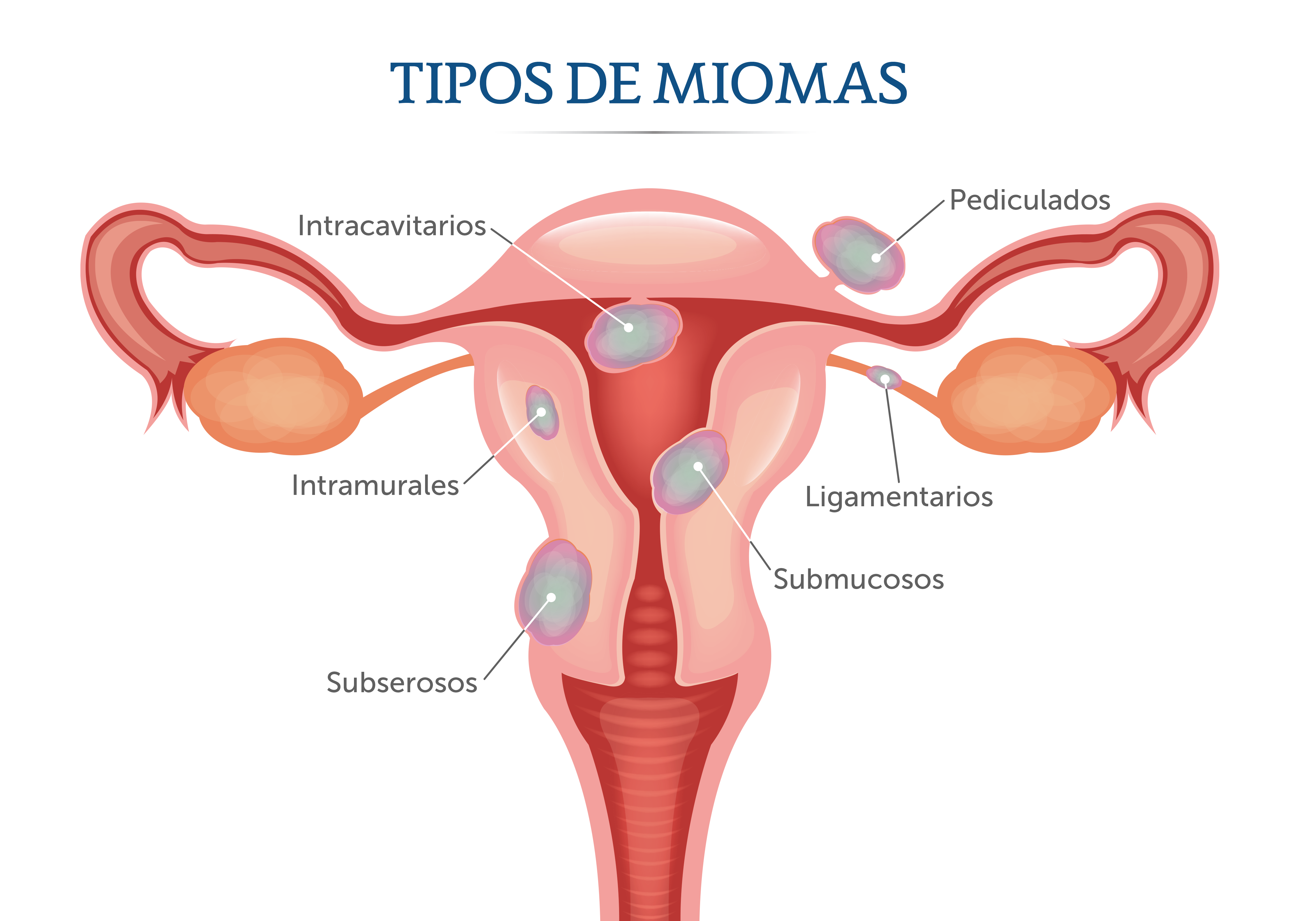 Médica Sur Tratamiento de miomas