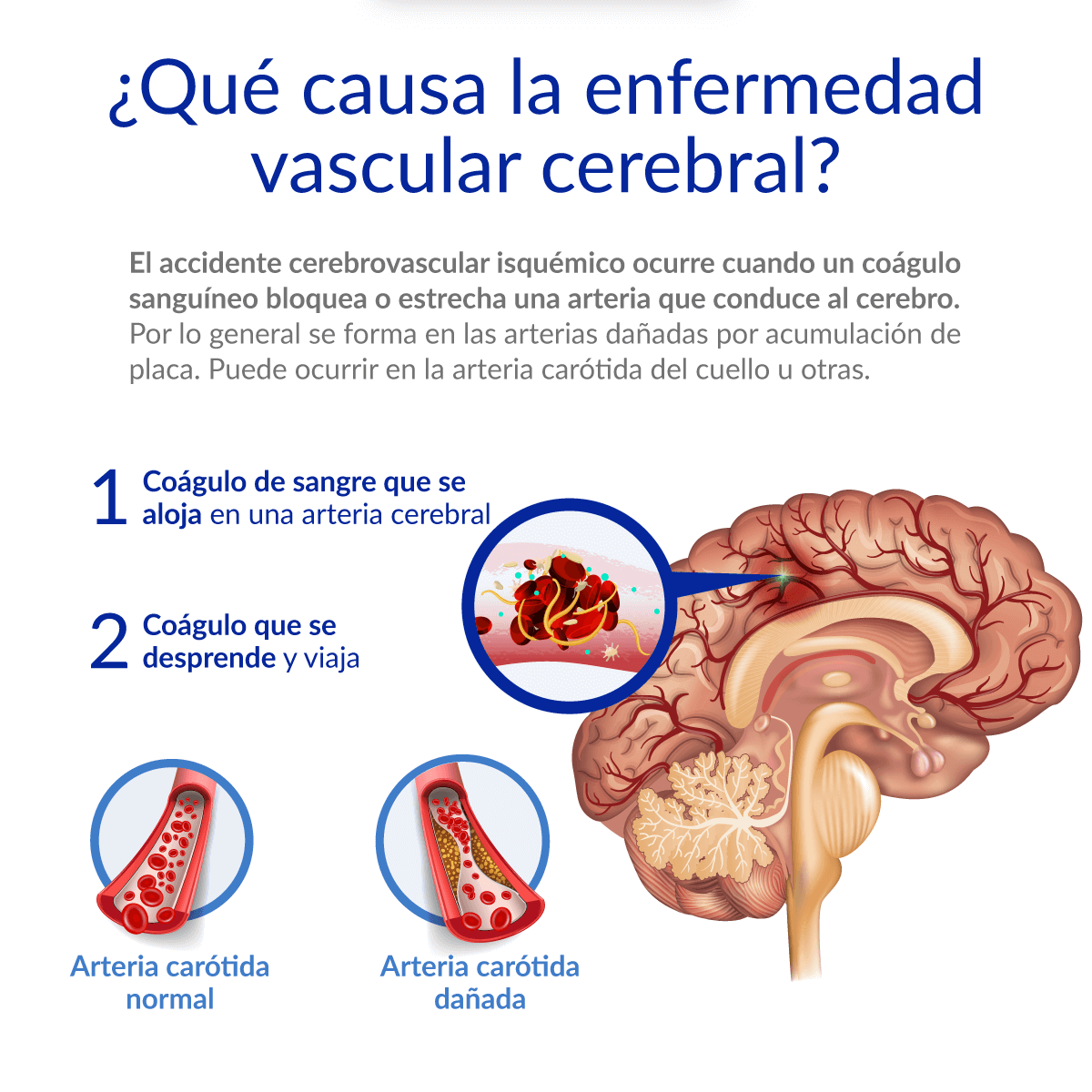 Qu causa la enfermedad cerebro vascular?