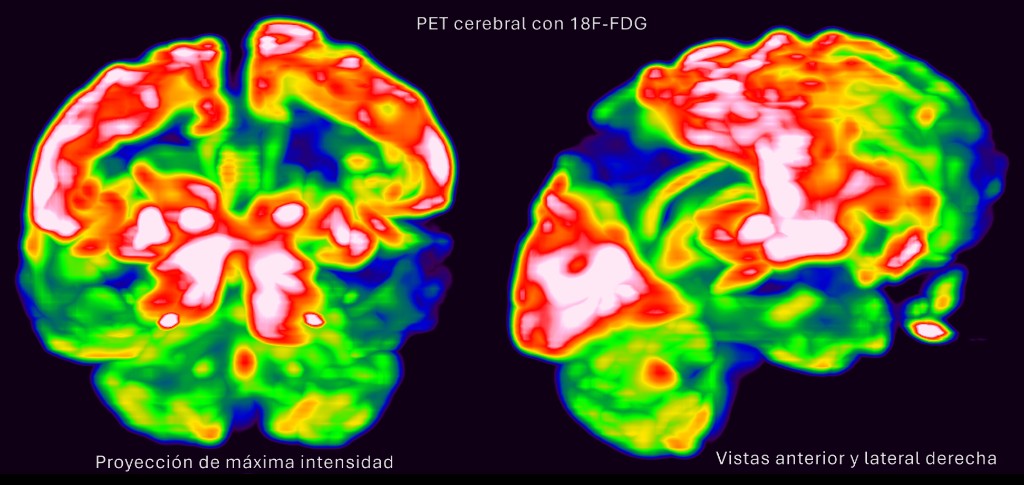 PET cerebral con 18F-FDG: proyección de máxima intensidad, vistas anterior y lateral derecha