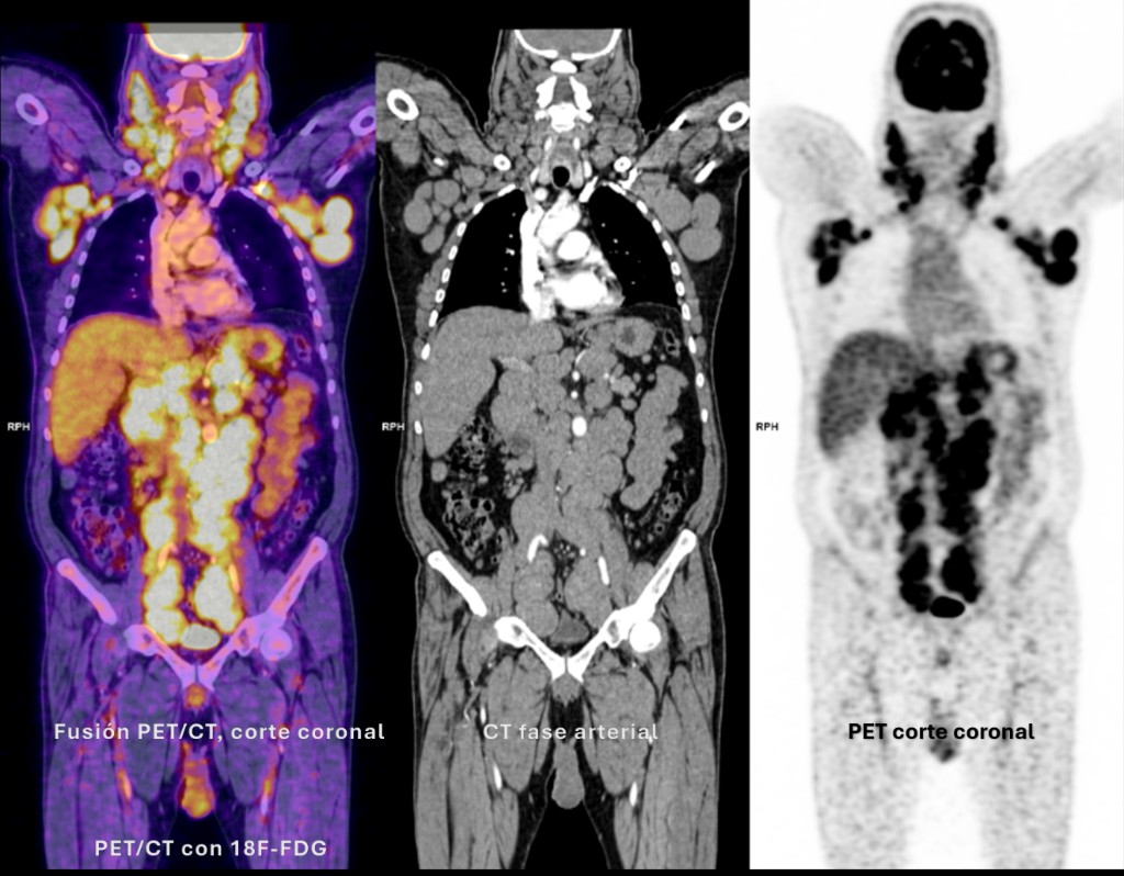 Fusión PET/CT coronal con 18F-FDG, CT fase arterial y PET corte coronal