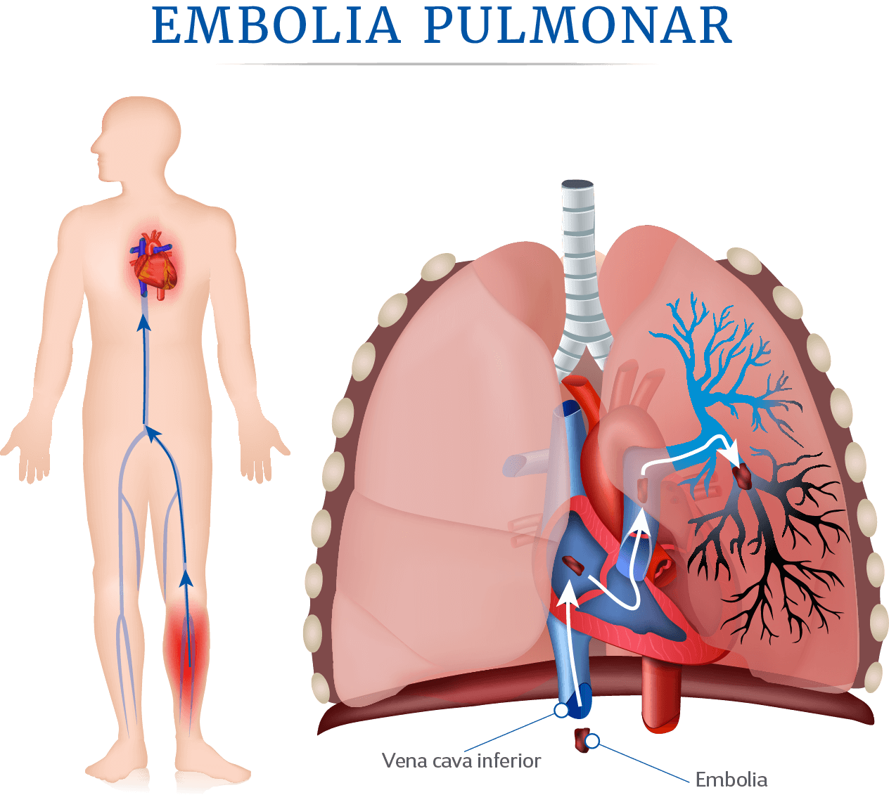 Trombosis y tromboembolia pulmonar