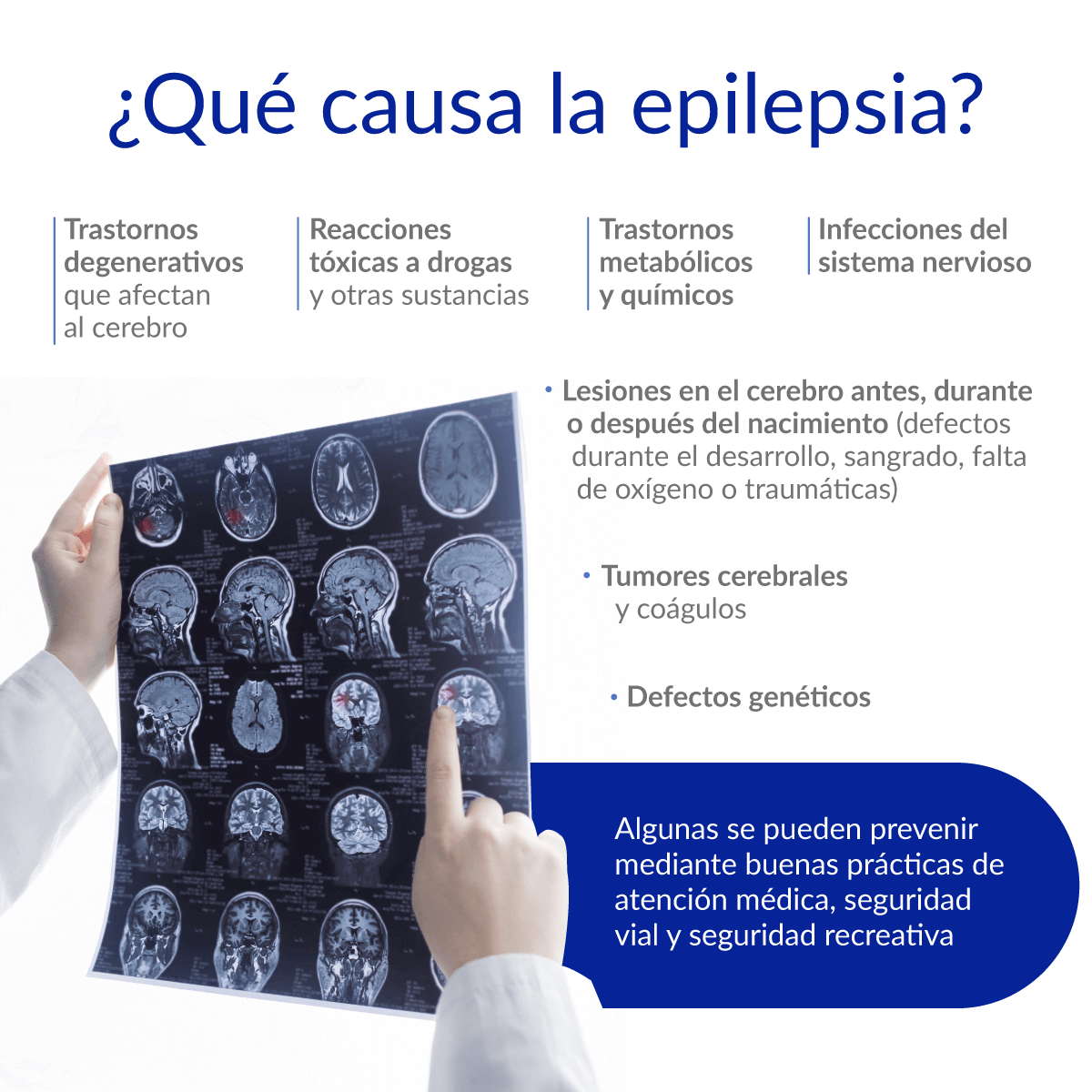 ¿Qué causa epilepsia?