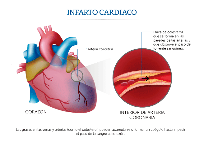 Ilustración sobre cómo ocurre un infarto cardiaco
