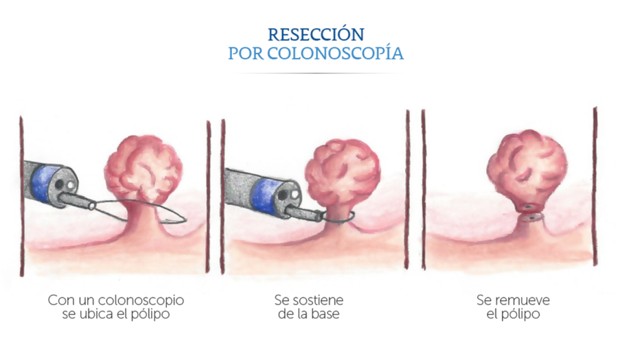 Resección por colonoscopía