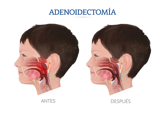 Iustración sobre la adenoidectomía