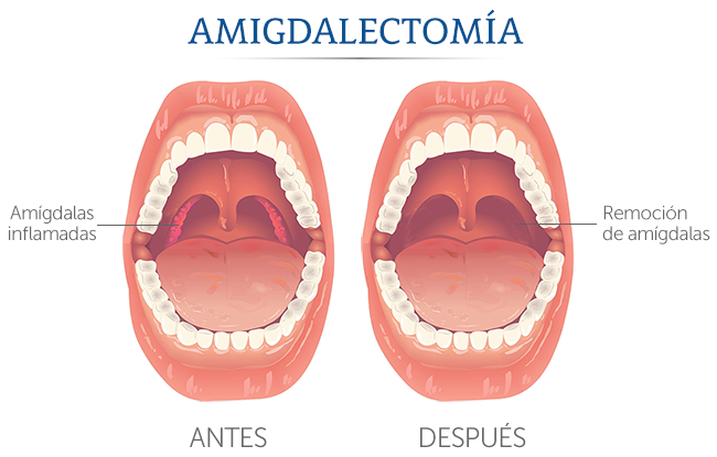 Ilustración de dos bocas abiertas antes de la amigdalectomía y después de la cirugía.