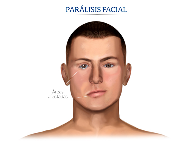 Signos de la parálisis facial