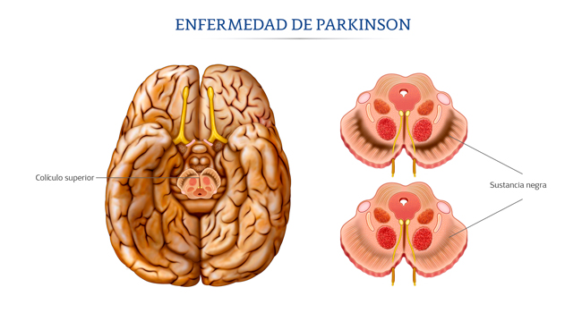 Ilustración de cerebro en la enfermedad de Parkinson