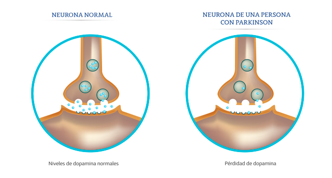Ilustración de una neuronas normal versus la neurona con Parkinson